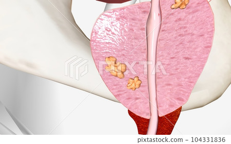 The Stage II Prostate Cancer The Stage II Prostate Cancer 104331836