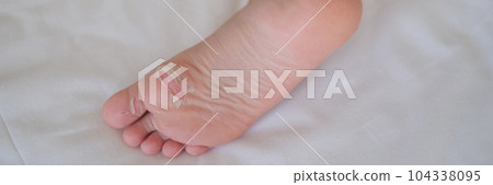 Heel of child with flaky skin after burn or injury closeup Heel of child with flaky skin after burn or injury closeup 104338095