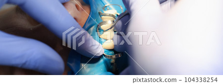 Doctor dentist fixing veneer on patient teeth using metal tools closeup Doctor dentist fixing veneer on patient teeth using metal tools closeup 104338254