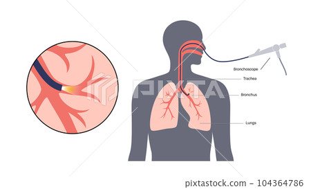 Bronchoscopy procedure concept 104364786