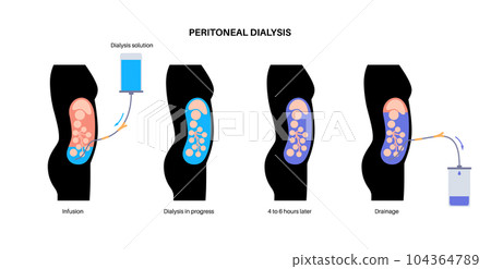 Peritoneal dialysis concept 104364789