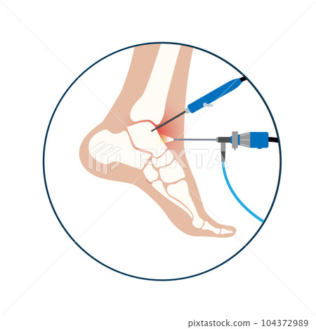 Ankle arthroscopy poster 104372989