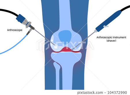 Knee joint arthroscopy Knee joint arthroscopy 104372990