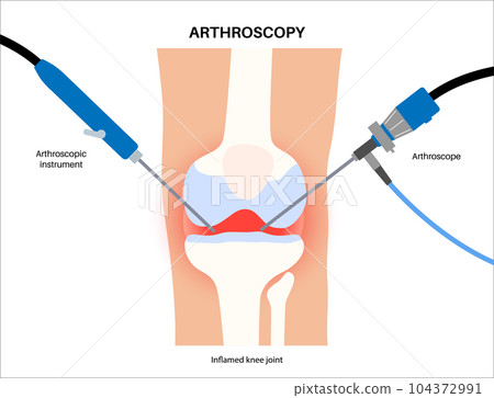 Knee joint arthroscopy 104372991