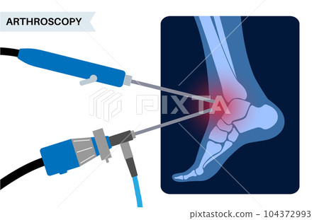 Ankle arthroscopy poster Ankle arthroscopy poster 104372993
