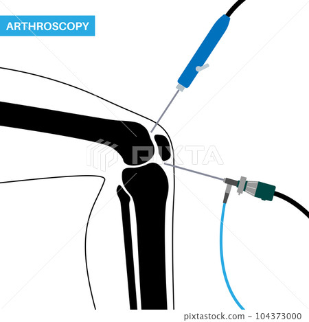 Knee joint arthroscopy 104373000