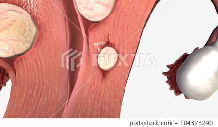Uterine fibroids are benign growths of tissue in the uterus. 104373290