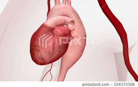 The Thoracic Aortic Aneurysm 3D The Thoracic Aortic Aneurysm 3D 104373306