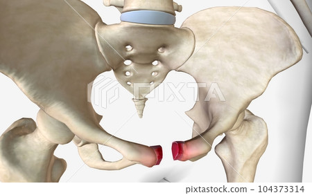 The Pubic Symphysis Diastasis 3D 104373314