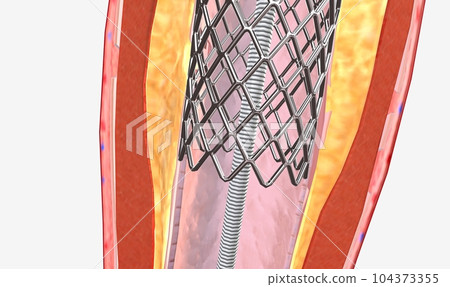 The balloon expends, widening the wire mesh stent and the artery 104373355