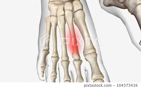 Stress fractures are injuries with small breaks in bones, usuall Stress fractures are injuries with small breaks in bones, usuall 104373416