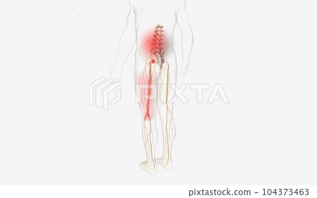 Back and Lower Limb Pain 104373463