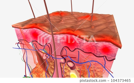 Kaposi is sarcoma is a type of cancer that forms in the lining of blood and lymph vessels 104373465
