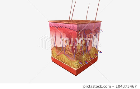 Necrotizing Fasciitis in Skin Tissue Necrotizing Fasciitis in Skin Tissue 104373467