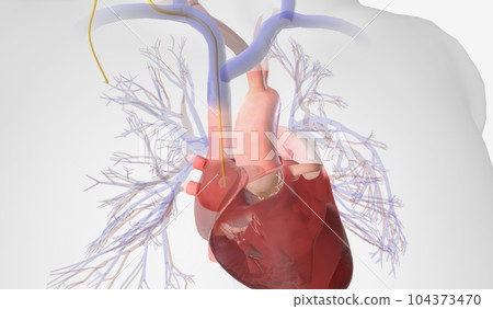 Pulmonary Artery Catheter Insertion into the Right Atrium 104373470