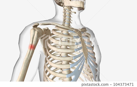 A fracture, called a broken bone , is an acute injury that causes a bone to break partially or completely. A fracture, called a broken bone , is an acute injury that causes a bone to break partially or completely. 104373471