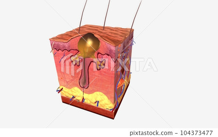 The Acne Open Comedone (Blackhead) The Acne Open Comedone (Blackhead) 104373477