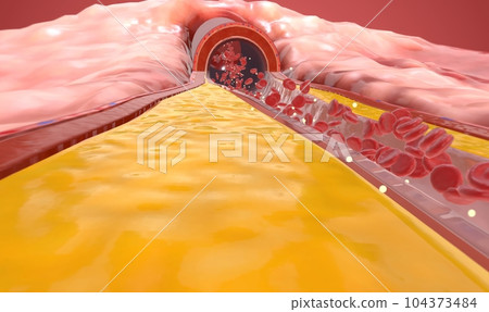 Hypercholesterolemia is a condition characterized by higher than Hypercholesterolemia is a condition characterized by higher than 104373484