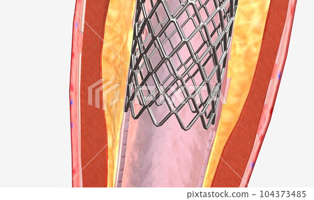 The balloon expends, widening the wire mesh stent and the artery 104373485
