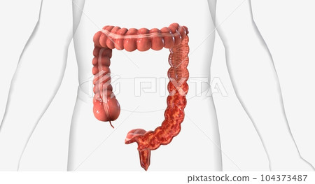 Ulcerative colitis chronic inflammation of the lining of the large intestine characterized by the formation of ulcers Ulcerative colitis chronic inflammation of the lining of the large intestine characterized by the formation of ulcers 104373487