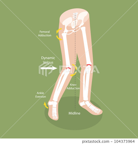 3D Isometric Flat Vector Conceptual Illustration of Mechanism Of Acl Injury 3D Isometric Flat Vector Conceptual Illustration of Mechanism Of Acl Injury 104373964