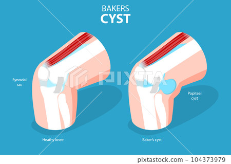 3D Isometric Flat Vector Conceptual Illustration of Bakers CYST 3D Isometric Flat Vector Conceptual Illustration of Bakers CYST 104373979