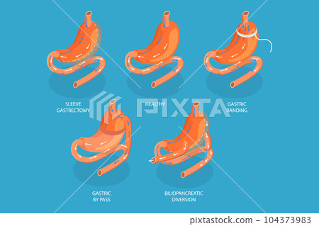 3D Isometric Flat Vector Conceptual Illustration of Types Of Bariatric Surgery 104373983