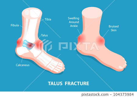 3D Isometric Flat Vector Conceptual Illustration of Talus Fracture 104373984