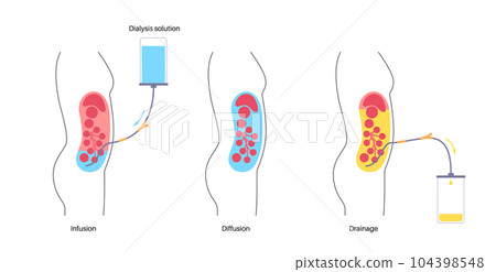 Peritoneal dialysis concept Peritoneal dialysis concept 104398548
