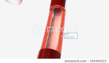 High volumes of lymphocytes, macrophages, and other immune cells infiltrate the inflamed aorta. 104400323