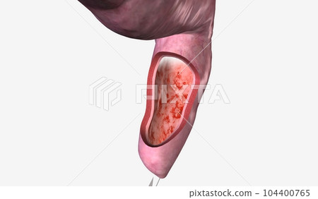 Proctitis is an inflammation of the rectum that causes discomfor 104400765