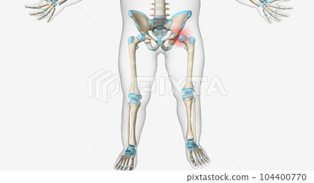 Hip dysplasia occurs when the hip socket is too shallow 104400770