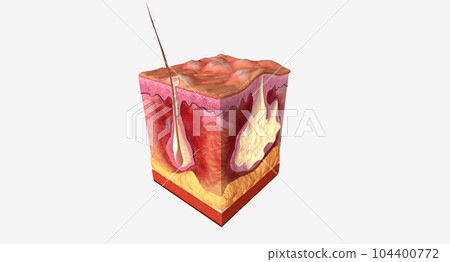 Hidradenitis suppurativa is a long-term skin condition characterized by the swelling of hair follicles. 104400772
