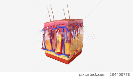 Angioedema is a swelling of the dermis and subcutaneous tissue. Angioedema is a swelling of the dermis and subcutaneous tissue. 104400778