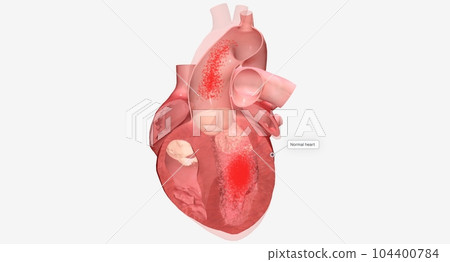 Cardiomyopathy is a disease of the heart muscle that causes the Cardiomyopathy is a disease of the heart muscle that causes the 104400784