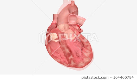 The Heart is Failure Medications 104400794