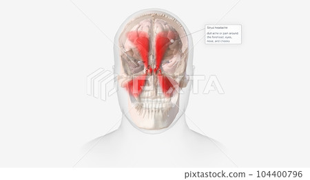 Sinus headaches are a type of headache characterized by a dull ache or pain around the forehead, eyes, nose, and cheeks. Sinus headaches are a type of headache characterized by a dull ache or pain around the forehead, eyes, nose, and cheeks. 104400796