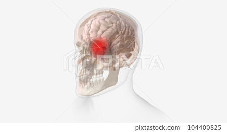 Cluster headaches are a rare and extremely painful type of headache. 104400825