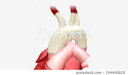 The enlarged portion of the aortic arch is replaced with a synthetic graft. The enlarged portion of the aortic arch is replaced with a synthetic graft. 104400828