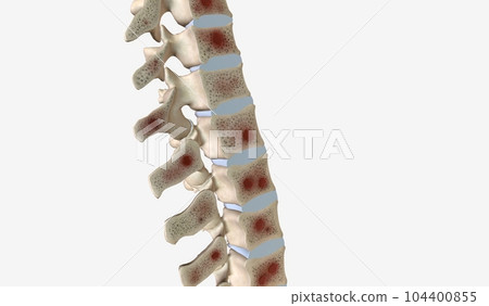 Multiple Myeloma on the Spine 104400855