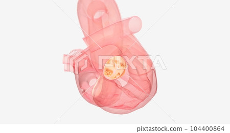 Narrowed aortic valve cannot open and close properly Narrowed aortic valve cannot open and close properly 104400864