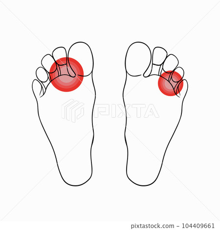 Vector isolated illustration of foot fungus. Contour drawing of foot fungus. Foot hygiene. Discomfort, itching of the fungus. Vector isolated illustration of foot fungus. Contour drawing of foot fungus. Foot hygiene. Discomfort, itching of the fungus. 104409661