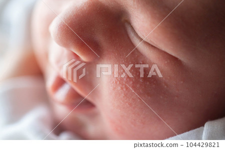 Pimples on the face of a newborn. Baby's adaptation to the environment, close-up Pimples on the face of a newborn. Baby's adaptation to the environment, close-up 104429821