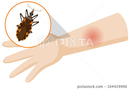 Human arm swollen from kissing bug bite Human arm swollen from kissing bug bite 104429998