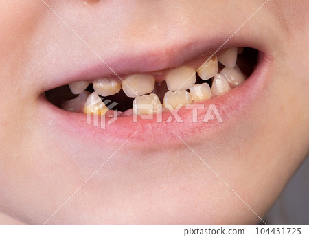 Mouth and smile of a child without one tooth. Loss of milk teeth in children, close-up Mouth and smile of a child without one tooth. Loss of milk teeth in children, close-up 104431725