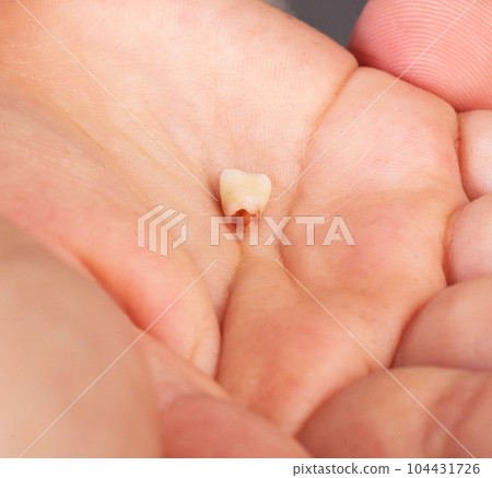 The child holds a milk tooth incisor in his hand. Extraction of milk teeth in children. Children's dentistry. Close-up The child holds a milk tooth incisor in his hand. Extraction of milk teeth in children. Children's dentistry. Close-up 104431726