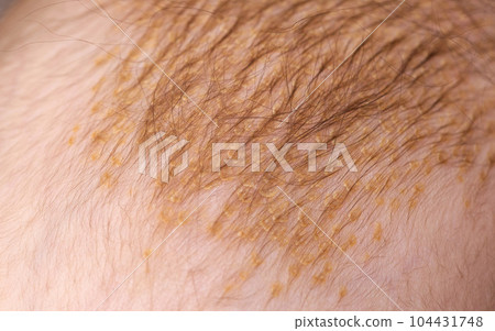 The process of formation of seborrheic dermatitis in an infant on the head. Scaly crusts, close-up 104431748