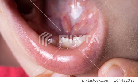 Crooked teeth in a child's mouth. The permanent tooth grows next to the milk tooth, close-up 104432085
