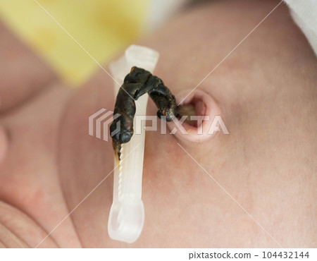 Remains of the umbilical cord with a clip in a newborn. Treatment and care of the navel in an infant. Close-up 104432144