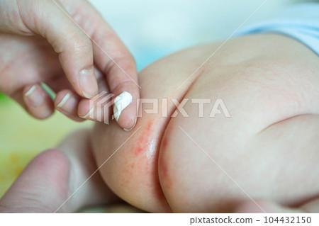The mother applies a healing cream to the baby's red bottom. Healing ointment for diaper rash, irritation and redness on the delicate skin of a baby, close-up 104432150